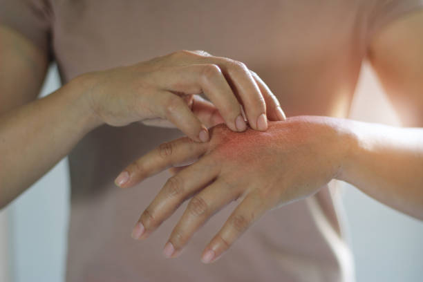 здравоохранение и медицинская концепция. самка царапает зуд на руке, вызывает зуд от кожных заболеваний, сухость кожи, аллергию, химическое - expressive hands стоковые фото и изображения