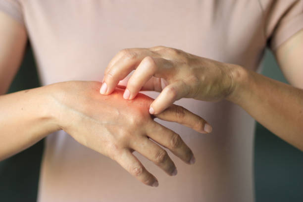 Healthcare and medical concept. Female scratching the itch on her hand, cause of itching from Allergy, chemical, allergic to detergent or dishwashing liquid and dermatitis, insect bites, burned, drug, skin diseases. Health problem. concepto de salud y médico. rayar el prurito por su parte, causa de picores de alergia, femenina químico, alérgico a líquido para lavar platos o detergente y dermatitis, picaduras de insectos, se quemó, drogas, enfermedades de la piel. problema de sal