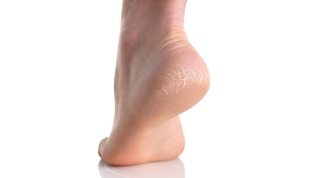 die ferse des fußes mit unreiner haut mit rissen bedeckt - smooth human skin human leg human foot stock-fotos und bilder