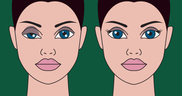 Ptosis of eyelid Ptosis of eyelid at woman, asymmetry of eyes, plastic surgery, operating correction of ptosis eyes girls. Vector illustration before and after drooping stock illustrations