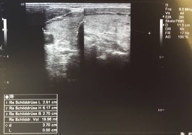 istock Sonography image of thyroid gland with nodular formation 1127486162
