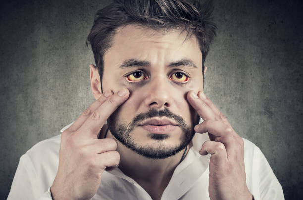 chory człowiek patrząc w lustro ma żółtawe oczy jako znak możliwego zakażenia wątroby lub innej choroby. - human eye men close up macro zdjęcia i obrazy z banku zdjęć