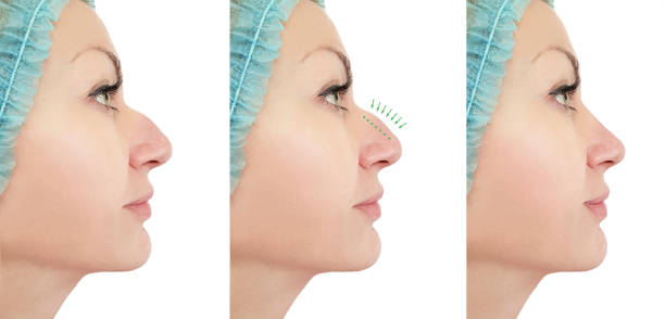 correction de nez femme avant et après les procédures retouche - hump photos et images de collection