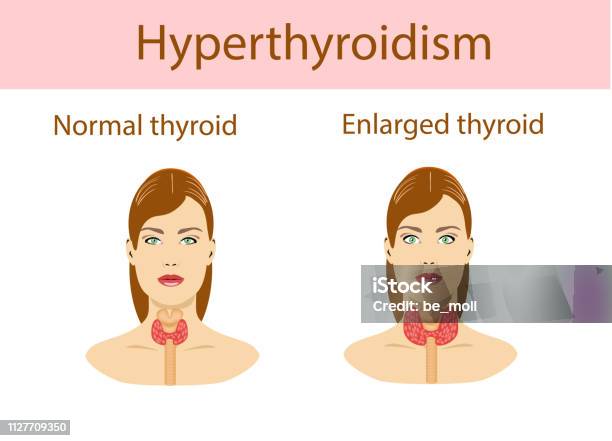 Hyperthyroid Animation Woman With Enlarged Hyperthyroid Gland Vector Illustration Stock ...