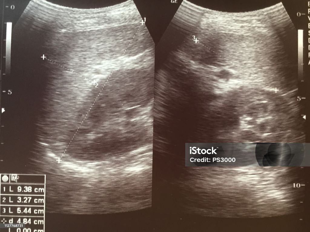 비장 및 신장 초음파 이미지 개념에 대한 스톡 사진 및 기타 이미지 - 개념, 개념과 주제, 건강 검진 - iStock