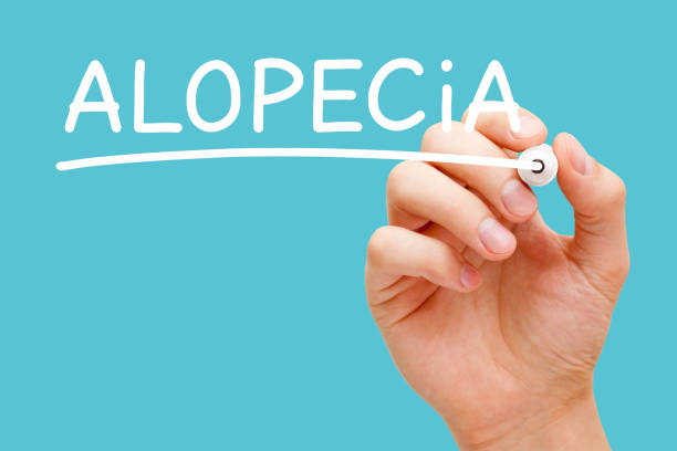 istock Alopecia Hair Loss Or Baldness Concept 1127813869