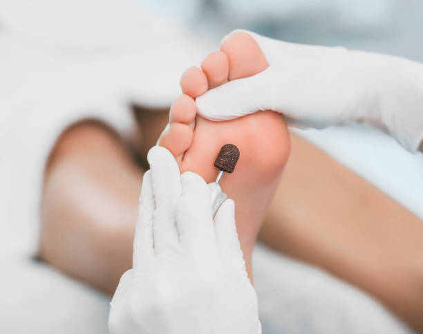 chiropodist rimuove la pelle indurita sul piede, utilizzando hardware. - podiatrist pedicure human foot toenail foto e immagini stock