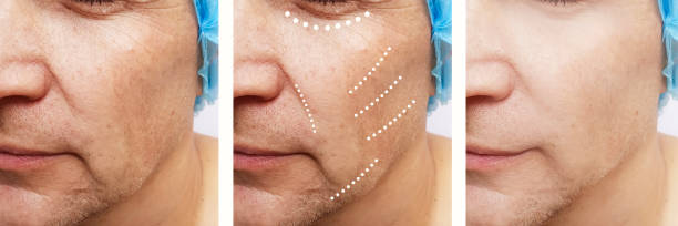 istock male wrinkles before and after correction retouching 1127847762