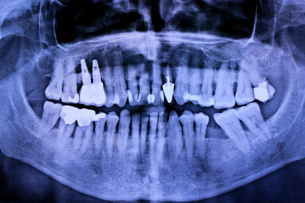 istock Details with a dental radiography (x-ray) 1128096846