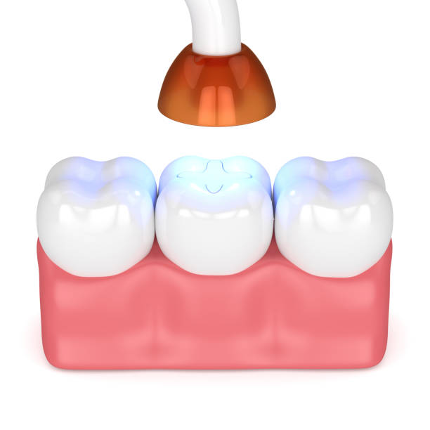 istock 3d render of teeth with dental polymerization lamp and light cured inlay 1128229964