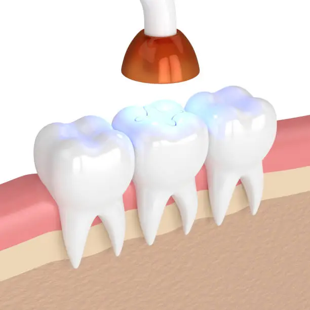 3d render of teeth with dental polymerization lamp and light cured inlay filling over white background