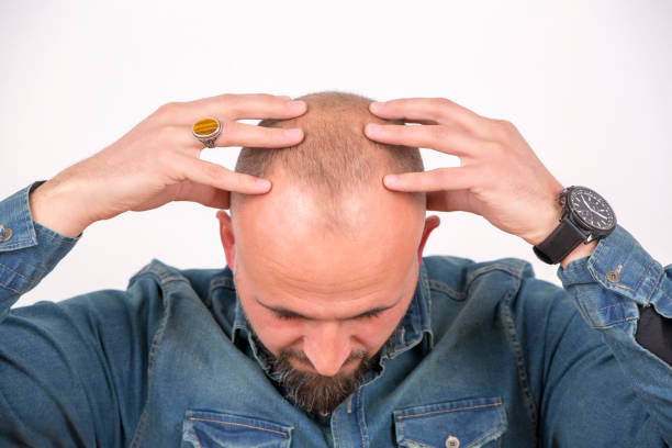 Hair loss white background Hair loss medicine and science drop close up studio shot stock pictures, royalty-free photos & images