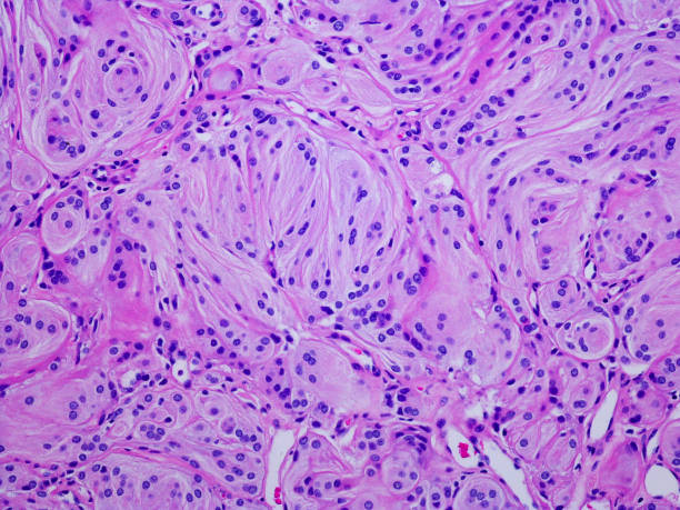 Micrograph of WHO grade I meningioma (brain tumor) WHO grade I meningioma- Brain tumours are graded from 1 - 4, according to what they look like under the microscope as well as their behaviour, such as the speed at which they are growing. Meningiomas can be graded 1, 2 or 3. Grade 1 Meningioma – the most common type, slow growing and less likely to return after treatment histology stock pictures, royalty-free photos & images