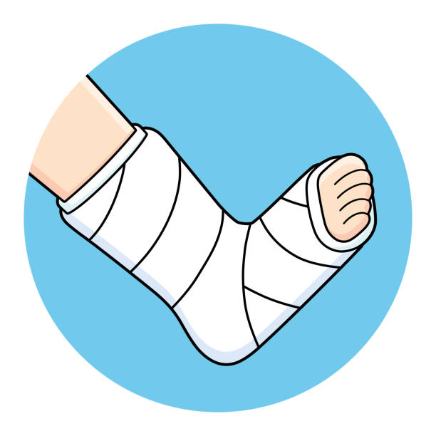 135 Broken Leg Cast Illustrations & Clip Art - iStock | Man broken leg cast 135 Broken Leg Cast Illustrations & Clip Art - iStock | Man broken leg cast