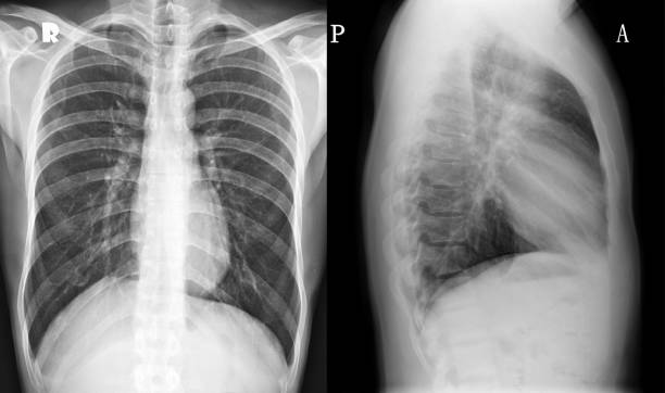 방사선 영상 - human lung x ray image x ray human spine 뉴스 사진 이미지
