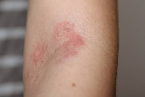 istock Allergy on the baby's hand close-up. Problem skin on the arm. 1128635931