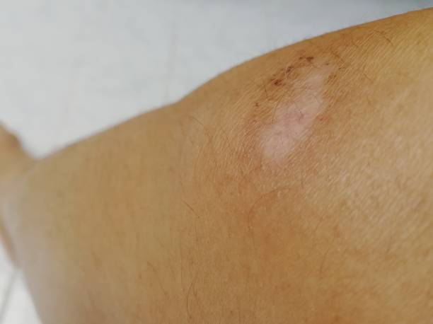 istock Skin after scab from fall down accident, slippery 1128673946