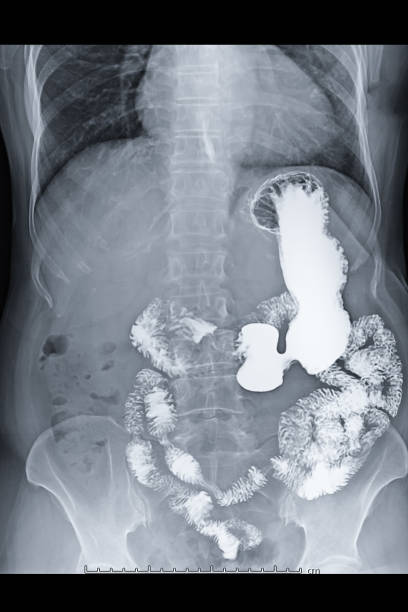 istock X-ray image of upper gastro-intestinal  demonstrate stomach  and small bowel. 1128680810