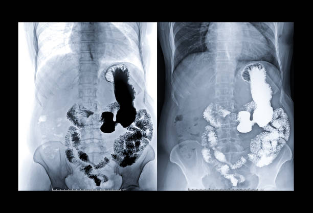 istock X-ray image of upper gastro-intestinal comparison invert filter and  non filter. 1128680833