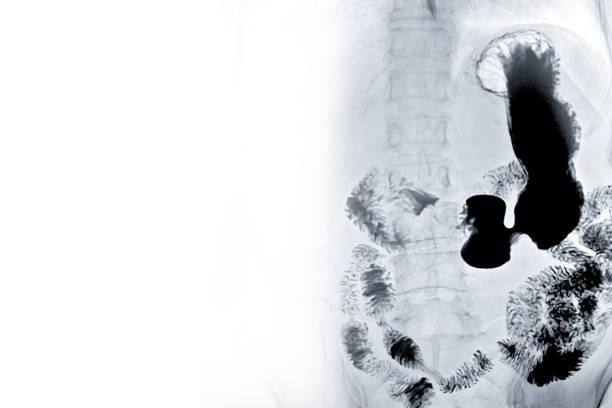 istock X-ray image of UGI study or upper gastrointestinal isolated on white background .medical background , backdrop concept 1128680958