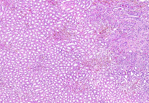 Histología de tejido humano, hinchazón turbia epiteliales del túbulo proximal del riñón de mostrar como se ve en el microscopio, zumbido de 10 x photo