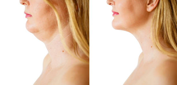 femme avant et après la procédure de correction fat de menton - tighten skin photos et images de collection