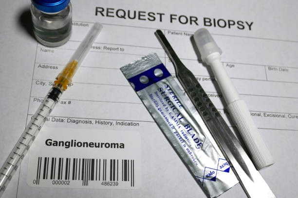 istock Ganglioneuroma biopsy 1128840285