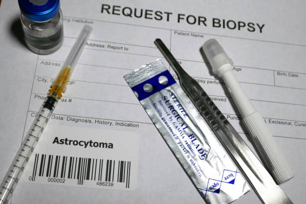 istock Astrocytoma biopsy 1128841163
