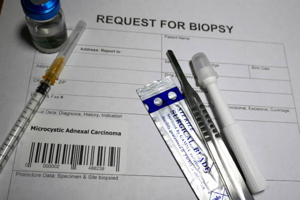 istock Microcystic adnexal carcinoma biopsy 1128845016
