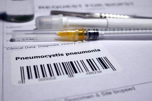 istock Pneumocystis pneumonia 1128845477