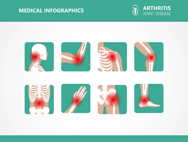 ilustraciones, imágenes clip art, dibujos animados e iconos de stock de reumatismo o desorden reumático médico establecido. dolor en las articulaciones artritis. infografía de vector de reumatología - rheumatic