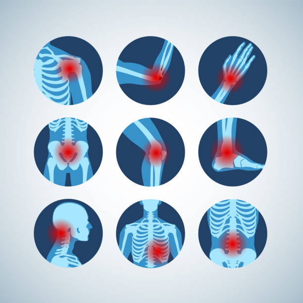 ilustraciones, imágenes clip art, dibujos animados e iconos de stock de reumatismo o desorden reumático médico establecido. dolor en las articulaciones artritis. infografía de vector de reumatología - rheumatic