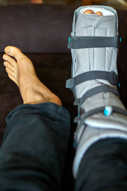 Break broken leg in a rail anatomie stock pictures, royalty-free photos & images