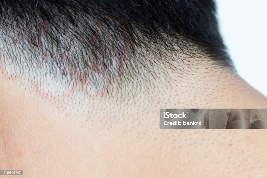 Closed Up Of Ringworm Stock Photo - Download Image Now - iStock Closed Up Of Ringworm Stock Photo - Download Image Now - iStock