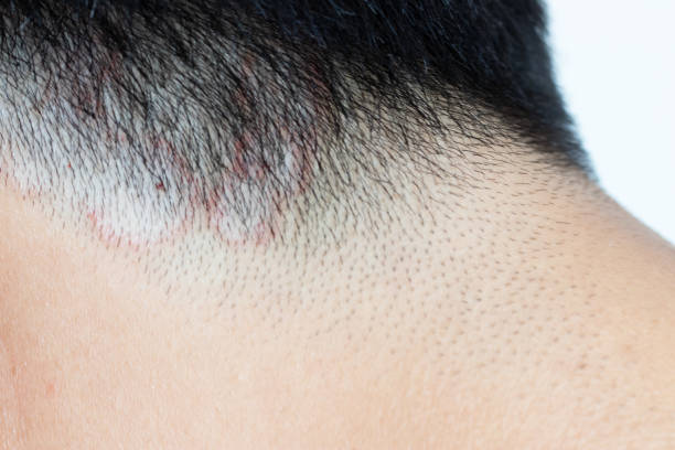 closed up of ringworm (tinea) on head of asian man (dermatitis) - frieiras imagens e fotografias de stock