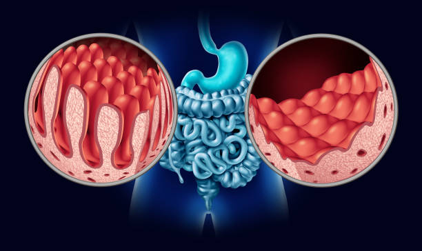 Celiac Coeliac Disease Celiac or coeliac disease as an intestine anatomy medical concept with normal villi and damaged small bowel lining as an autoimmune disorder of the digestion system with colon and stomach as a 3D illustration. gastroenterology photos stock pictures, royalty-free photos & images
