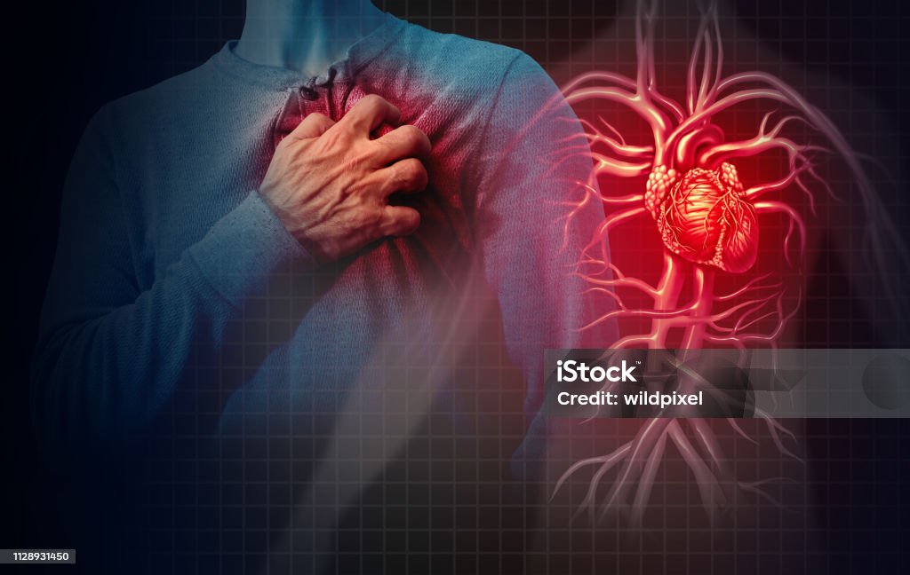 Heart Attack Concept Heart attack concept and human cardiovascular pain as an anatomy medical disease concept with a person suffering from a cardiac illness as a painful coronary event with 3D illustration style elements. Heart Attack Stock Photo