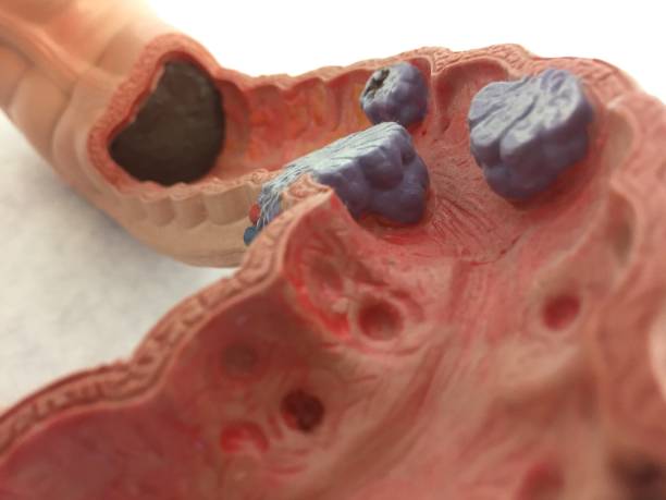 Old anatomical model of human intestines. Colon Cancer Old anatomical model of human intestines. Showing examples of diverticulum, inflammation, adenoids and cancer medical diagram photos stock pictures, royalty-free photos & images