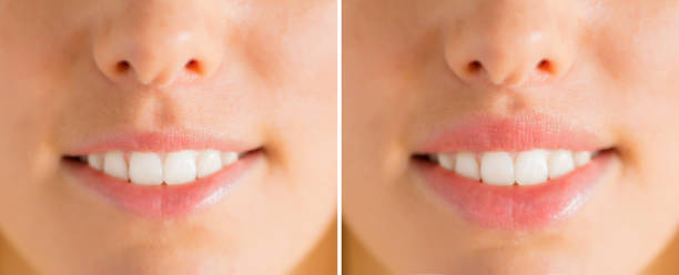 Woman's lips before and after filler injections Close-up photo of woman's lips before and after filler injections botox before and after stock pictures, royalty-free photos & images