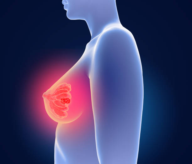 3d ilustración de cáncer de mama - mammakarzinom - seno ilustraciones fotografías e imágenes de stock