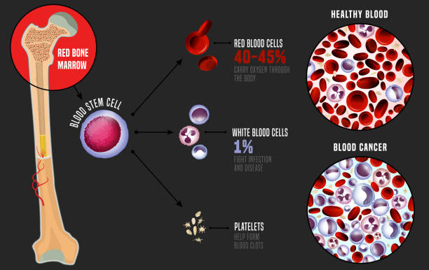 Leukemia medical infographic Leukemia and normal blood under the microscope in comparison. Medical infographic. Blood cells production scheme. Vector illustration on a grey background. Scientific concept. Horizontal poster. stem cell illustrations stock illustrations