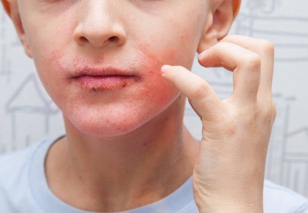 istock Boy scratching his face. Human skin, presenting an allergic reaction, allergic rash on face and lips. 1129193847