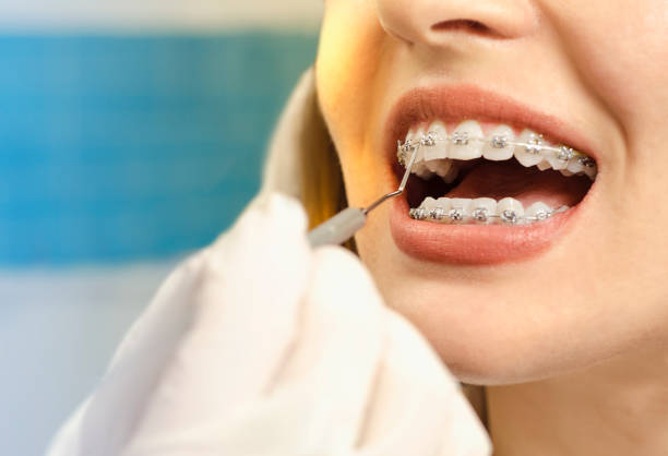 Closeup dental braces checkup Closeup dental braces checkup , perfect white teeth with dental braces woman in half smile brace stock pictures, royalty-free photos & images