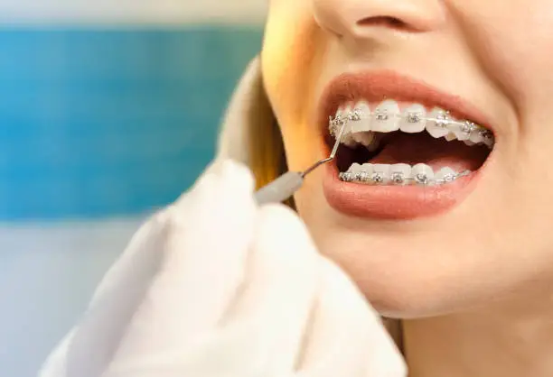 Closeup dental braces checkup , perfect white teeth with dental braces woman in half smile