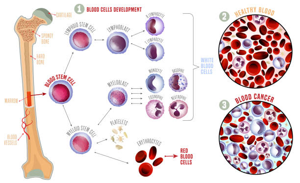 白血病医療インフォ グラフィック - blood cell red blood cell blood stem cell点のイラスト素材／クリップアート素材／マンガ素材／アイコン素材