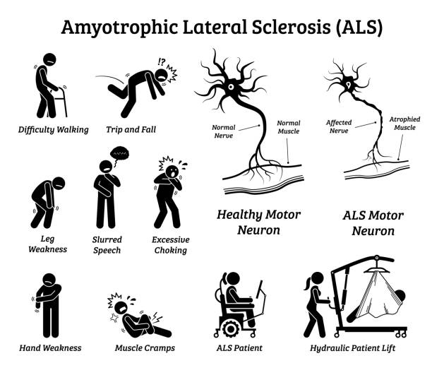 Amyotrophic lateral sclerosis ALS disease signs and symptoms. Illustrations depict nervous system or neurological disease in ALS patient. nerve cell illustrations stock illustrations