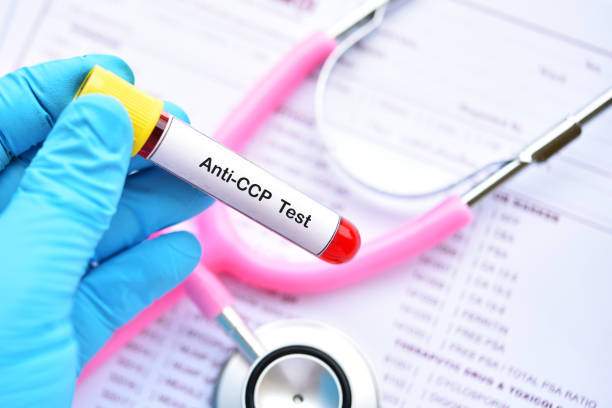 Blood sample tube for anti-CCP test Blood sample tube for anti-CCP test, diagnosis for rheumatoid arthritis disease autoantibody stock pictures, royalty-free photos & images