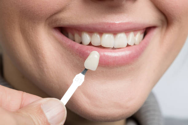 istock Using shade guide at mouth to check veneer of tooth crown 1129411429