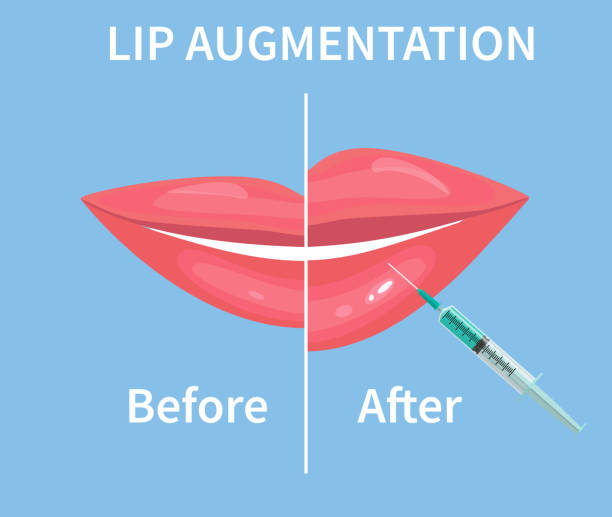 lippenvergrößerung. vor und nach der lippe füllstoff injektionen. vektor-illustration - big lips stock-grafiken, -clipart, -cartoons und -symbole