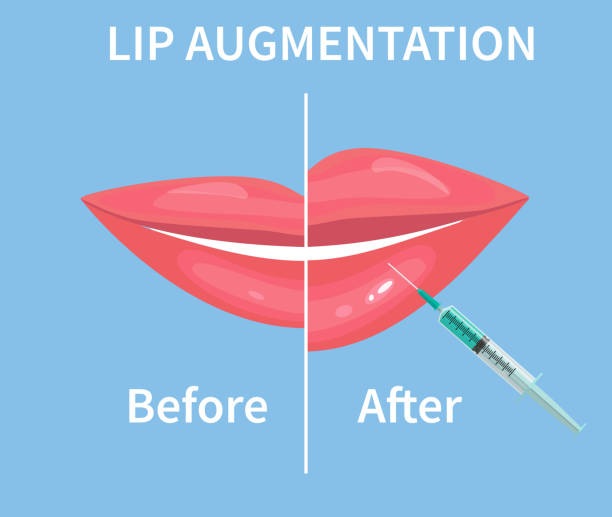 ilustrações, clipart, desenhos animados e ícones de aumento do lábio. antes e após as injeções de preenchimento labial. ilustração vetorial - big lips